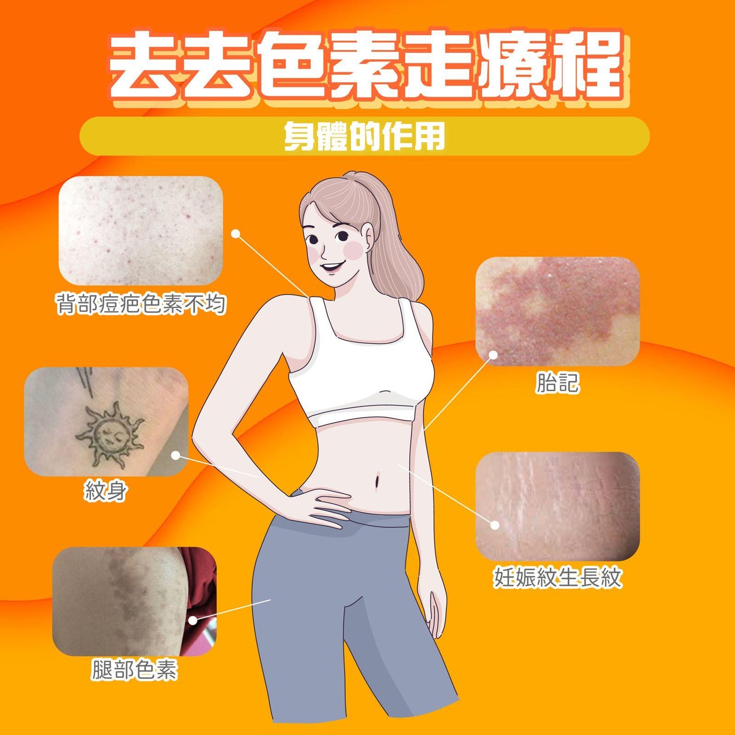 Pico 去去色素走療程 (身體)