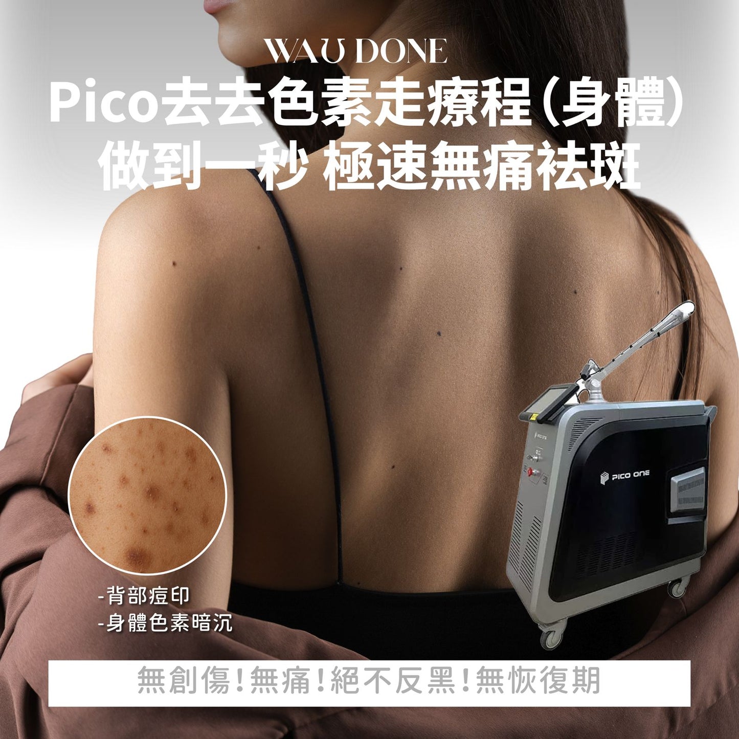 Pico 去去色素走療程 (身體)